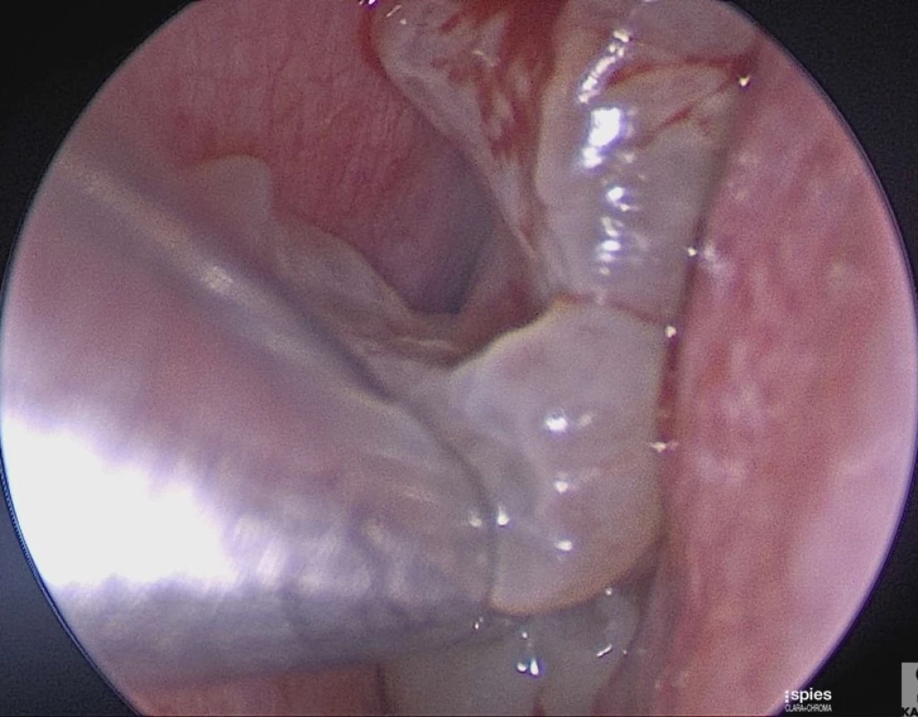 Endoskopický pohled do dutiny nosní vlevo, polypy patrné na pravé straně obrázku, odstraňování nosních polypů pomocí shaveru (na obrázku vlevo) při FESS