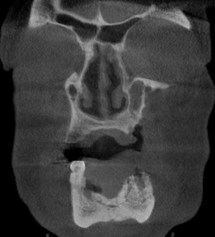 CB CT pacienta z obr. 2, 3, koronární řez – v dolní čelisti ve frontálním úseku je patrný odlučující se kostní sekvestr.