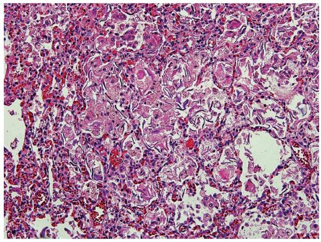 Penovité makrofágy a skvamózne epitélie vypĺňajúce pľúcne alveoly (hematoxylín-eozín, zväčšenie 200x).
