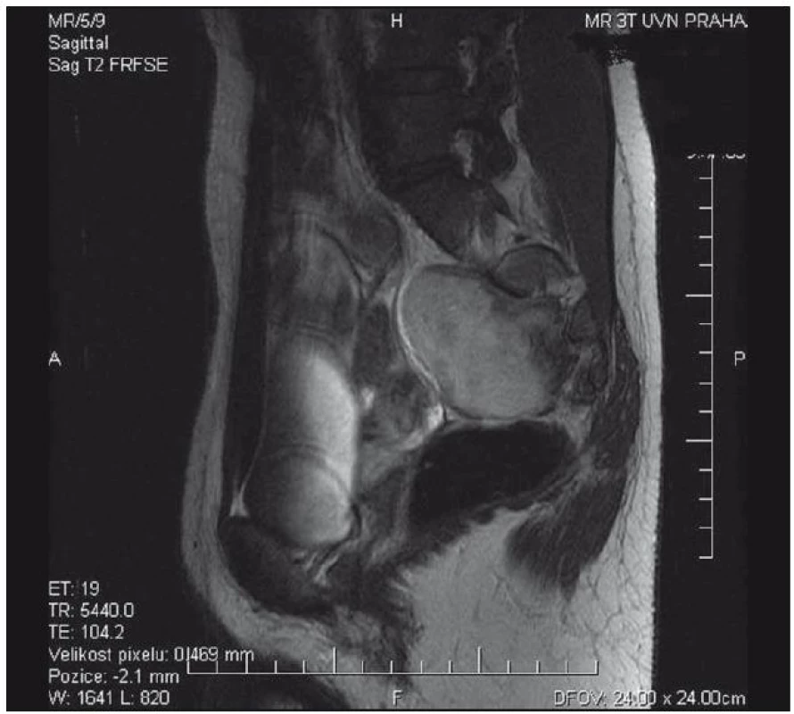 MR obraz v T2 váženém obraze presakrálně vyrůstajícího ganglioneuromu ventrálně naléhajícího na konkávní plochu kosti křížové vlevo s mírnou propagací do foramen S2.
