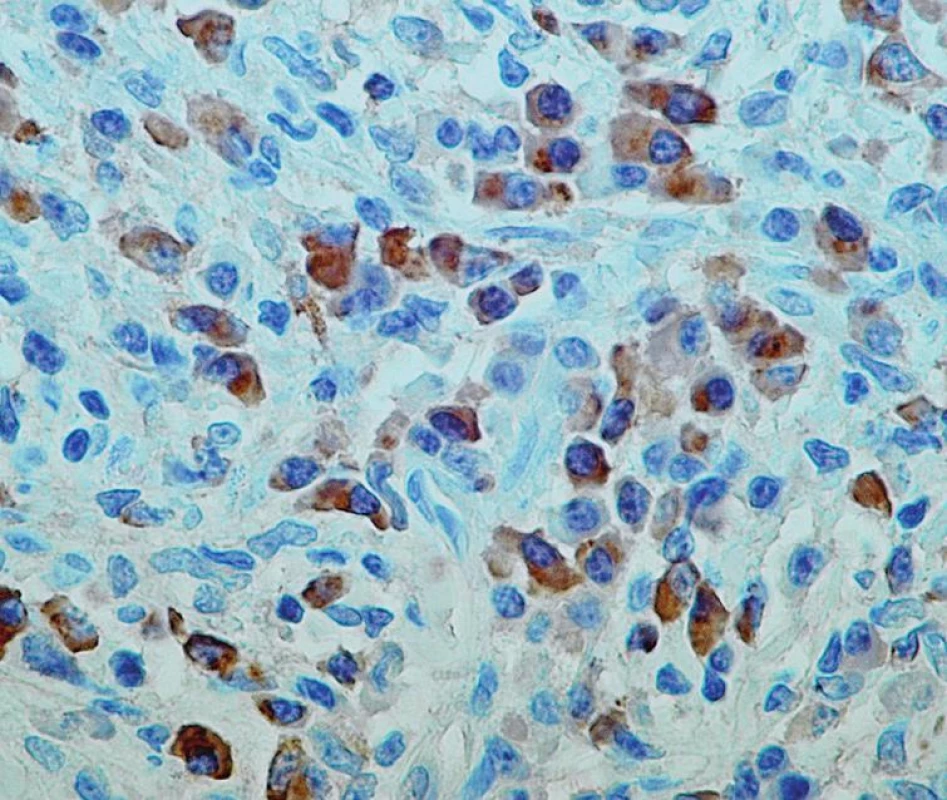 Detail zánětlivé celulizace s pozitivním imunohistochemickým průkazem IgG4 v četných plazmocytech (imunohistochemický průkaz IgG4, zvětšení 40krát)