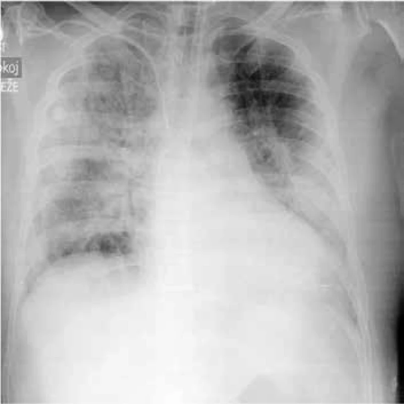 RTG hrudníku – pneumonie