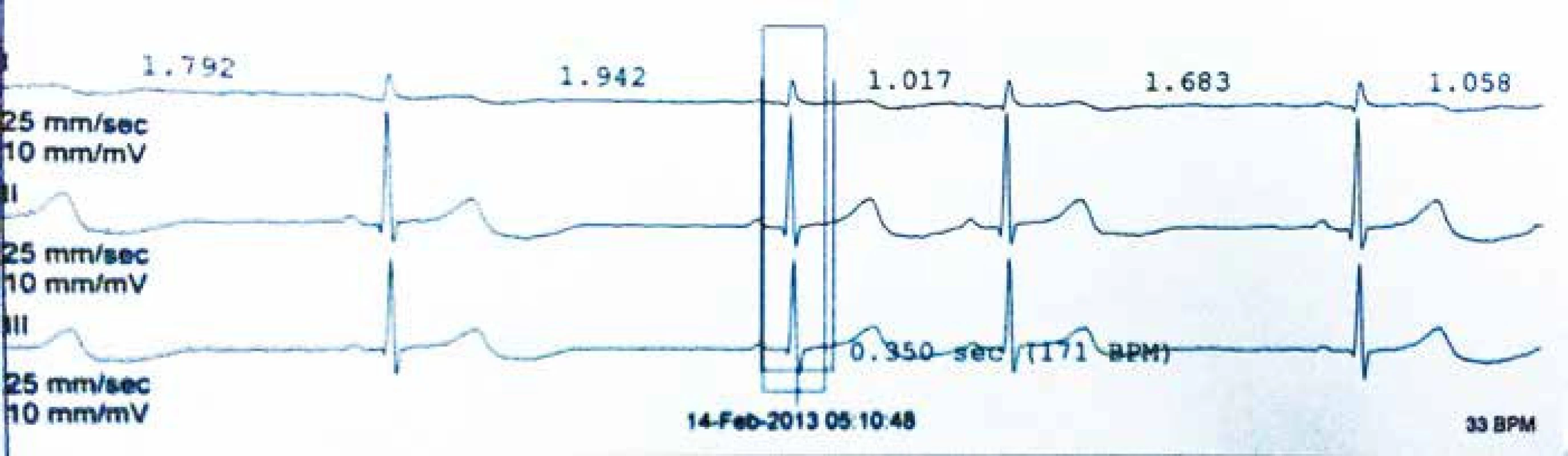 Minimální TF během Holterovy monitorace – sinusová bradykardie 33/min.