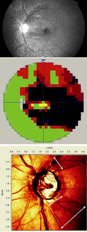 Ukázka korelace velkého výpadku VNV ve snímku sítnice (a) s perimetrickým vyšetřením (b) a vyšetřením pomocí HRT2 (c)