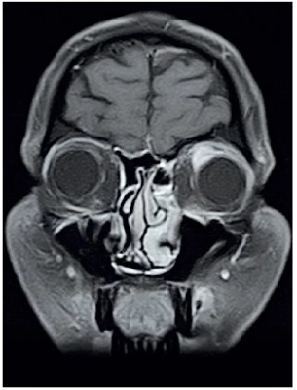 MRI očnic T1 vážený obraz, FSAT, koronární řez, kontrast Dotarem – opacifikace infiltrátu v levé orbitě