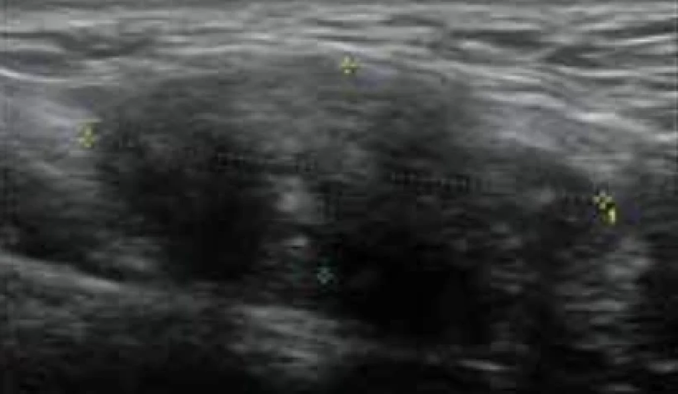 Ultrasonic image of the nodule. // Ultrazvukový obraz uzliny.