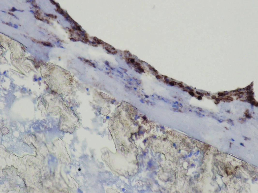 Immunohistochemical proof of expression of leukocyte common antigen (LCA) in the cells of lympho-plasmocytic inflammatory infiltration in fibrous pseudomembrane on the surface of the graft