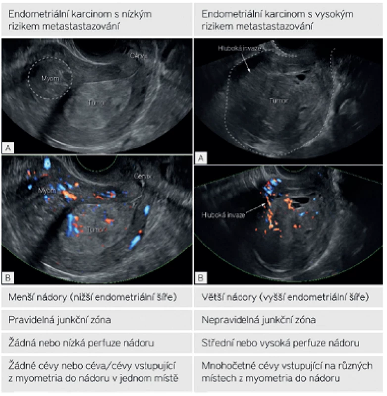 Ultrazvukové sonomorfologické a dopplerovské charakteristiky zhoubného nádoru endometria s nízkým a vysokým rizikem metastázování do lymfatických uzlin