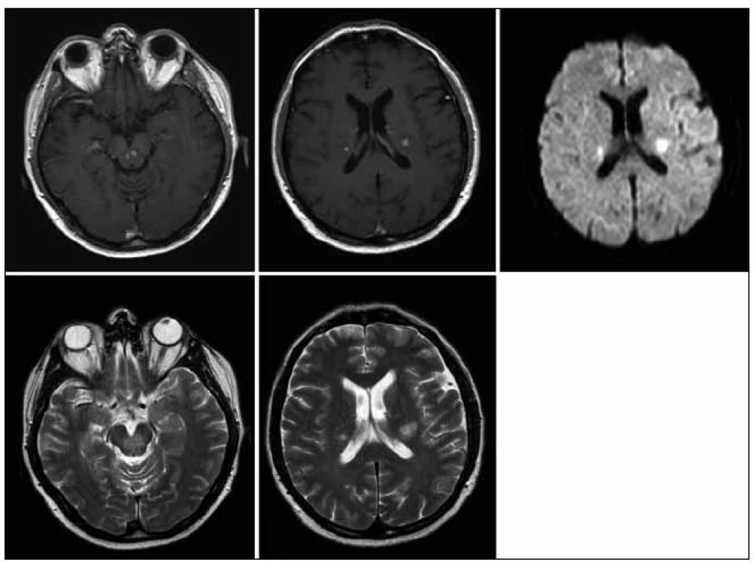 MR zobrazení mozku z 28. 5. 2009. Pokud považujeme 1. vyšetření (22. 1. 2009) jako vyšetření referenční před léčbou, pak se na 1. kontrole v průběhu léčby (28. 5. 2009) obraz nijak nemění, velikost i sycení ložisek infrai supratentoriálně je stejné.