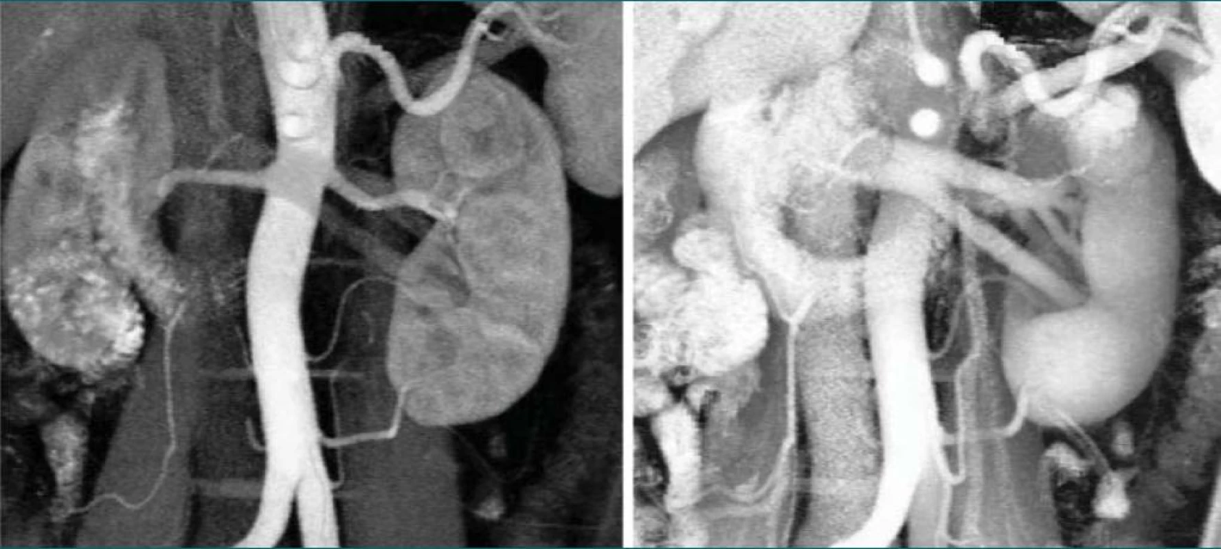 a, b. Dvoufázová CT angiografie ukazující cévní zásobení levé ledviny.