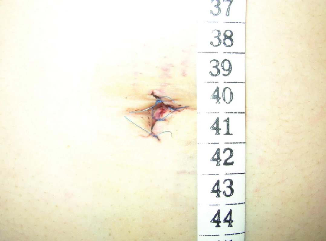 Operačná rana po SILS cholecystektómii
Fig. 2. Operating wound after SILS cholecystectomy