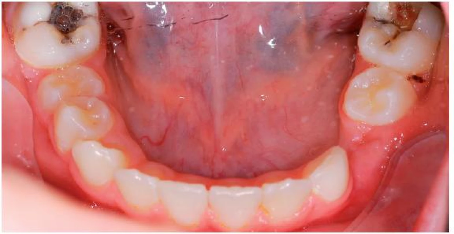 Dolní zubní oblouk před extrakcí kazem destruovaných zubů 36 a 46, perzistence 73, atypický průběh erupce v levém dolním postranním úseku chrupu