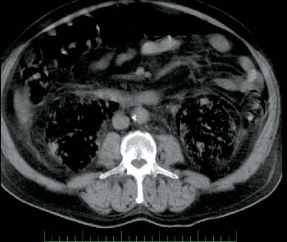 Rozsáhlé oboustranné postižení ledvin
Fig. 1. Extensive bilateral affection of kidneys