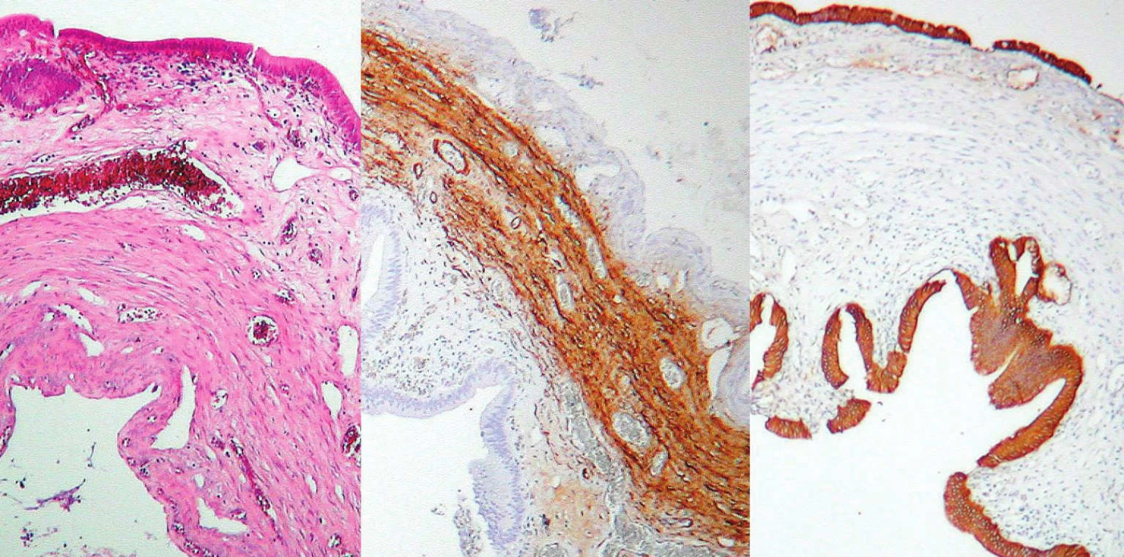 Histologický nález – multicysta, vľavo normálne farbenie, v strede zhrubnutá svalovina, vpravo epitel
Fig. 8. Histological preparation – multicyst: normal staining on the left, thick muscle layer in the middle, epithelium on the
right