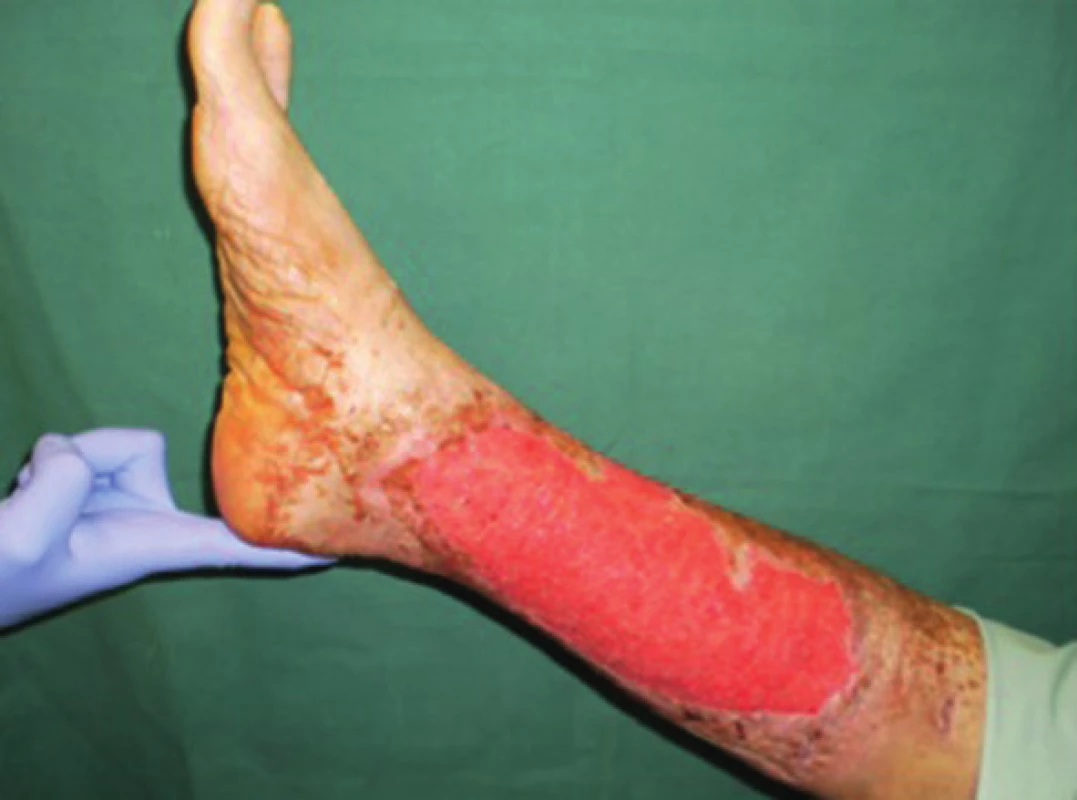 Pacient č. 3 − chronický kožní defekt po débridement a VAC péči trvající 6 dnů
Fig. 1: Patient No. 3 − chronic wound after debridement and 6 days of VAC therapy