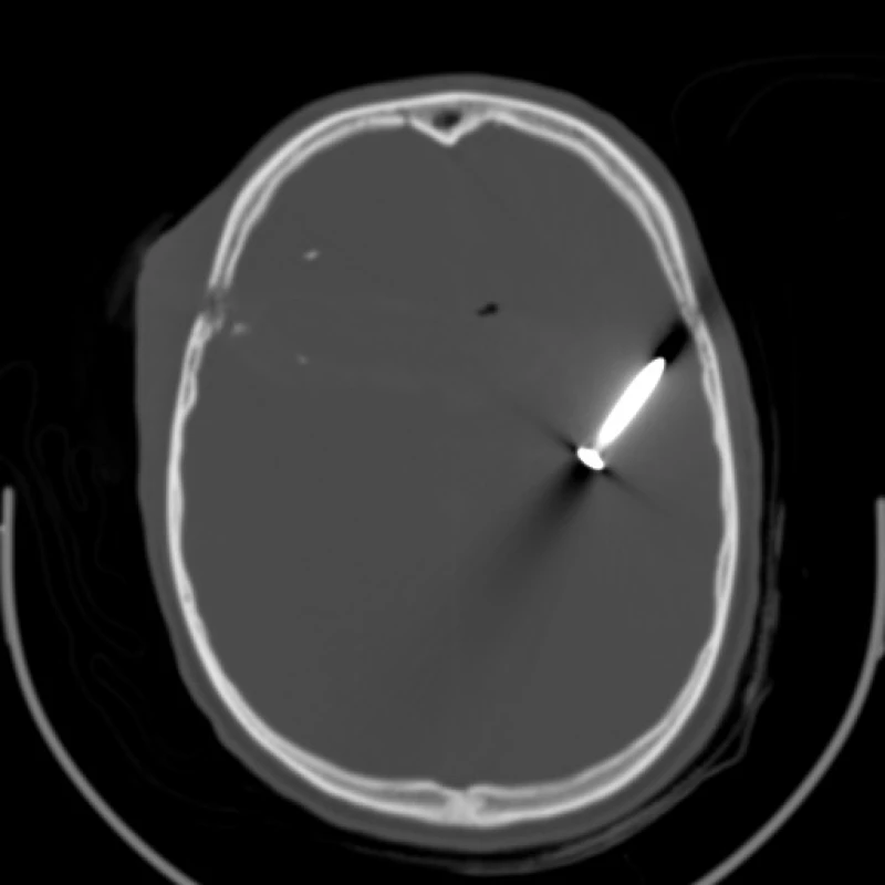 Poúrazové CT- kostní okno: vstřel v kalvě frontálně vpravo, cizí těleso v levé polovině krania