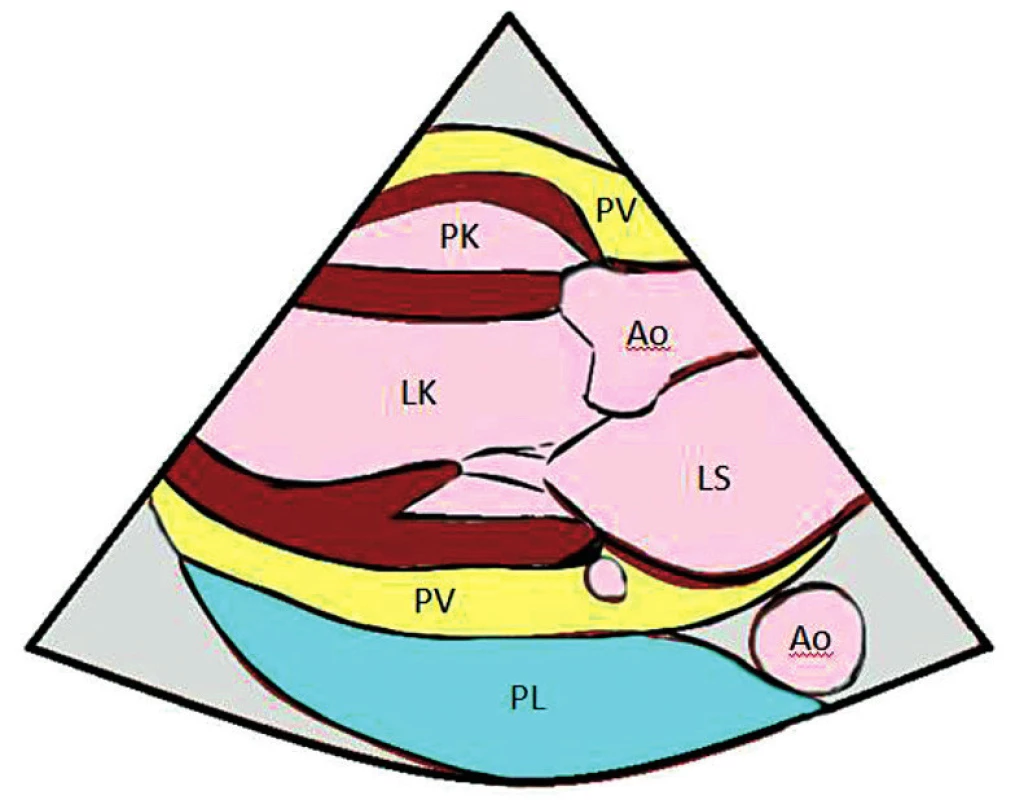 PLAX – parasternální projekce na dlouhou osu – odlišení pleurálního a perikardiálního výpotku
PV – perikardiální výpotek, PK – pravá komora, LK – levá komora, Ao – aorta, LS – levá síň, PL – pleurální výpotek