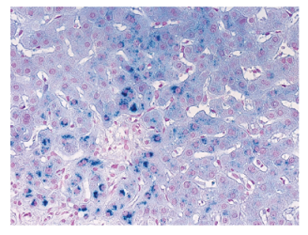 Schmorlova reakce s modrými granuly akumulovaného metaloproteinu v periportálních hepatocytech, používaná jako jednoduchý a rychlý průkaz poruchy žlučové drenaže. Schmorlova reakce, zvětšení objektiv 40x.