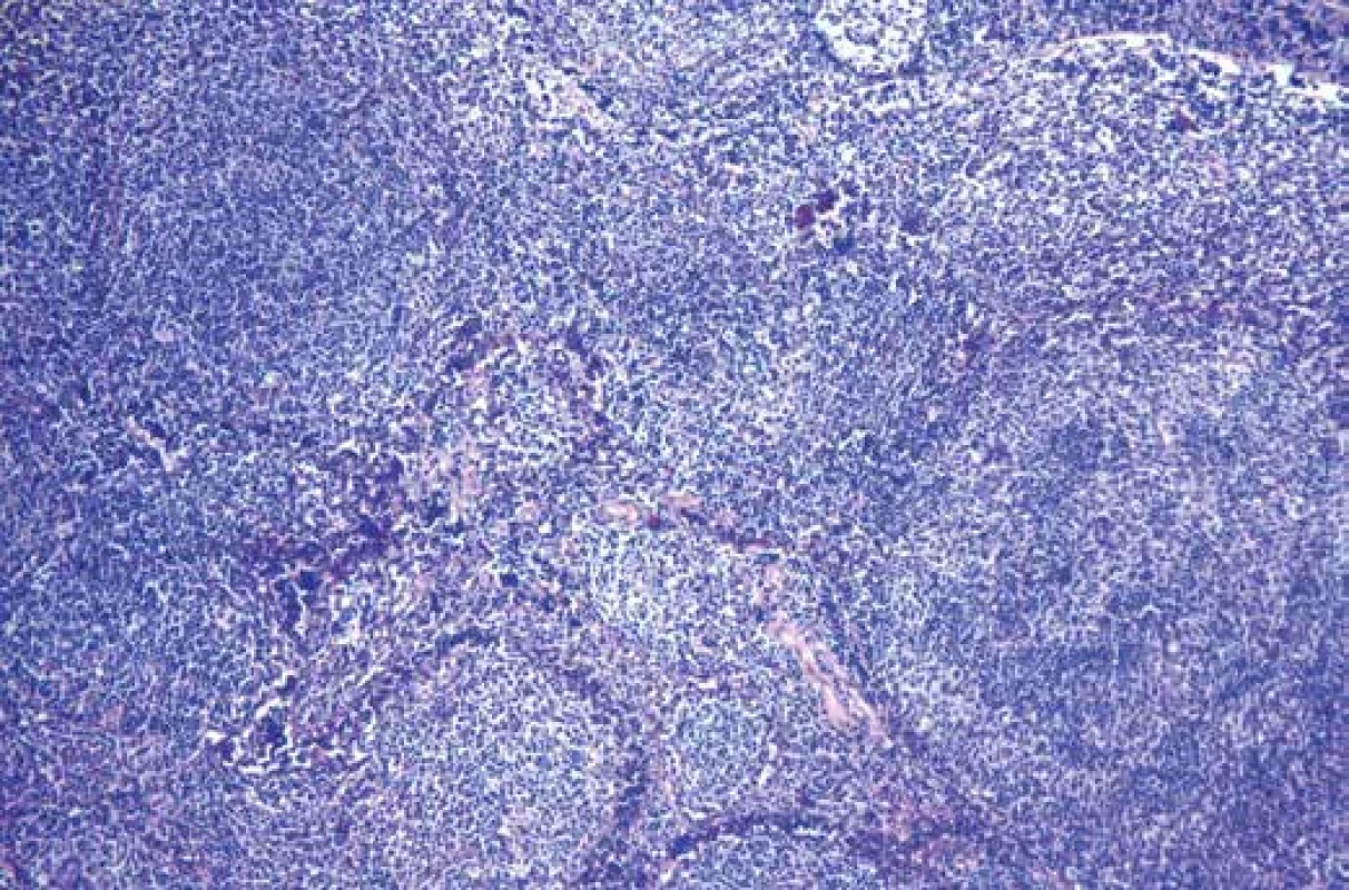 Mikroskopický obraz lymfatické uzliny setřelé folikulárně uspořádaným lymfoidním infiltrátem. Hematoxylin-eosin, zvětšení 40x.