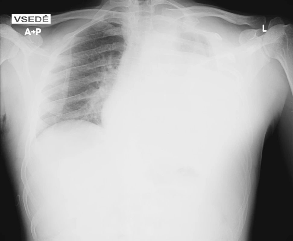 Snímek hrudníku při přijetí, na kterém je patrné zastření téměř celého levého hemitoraxu 
Fig. 1 Admission chest x-ray, with opacity covering nearly all of the left hemithorax