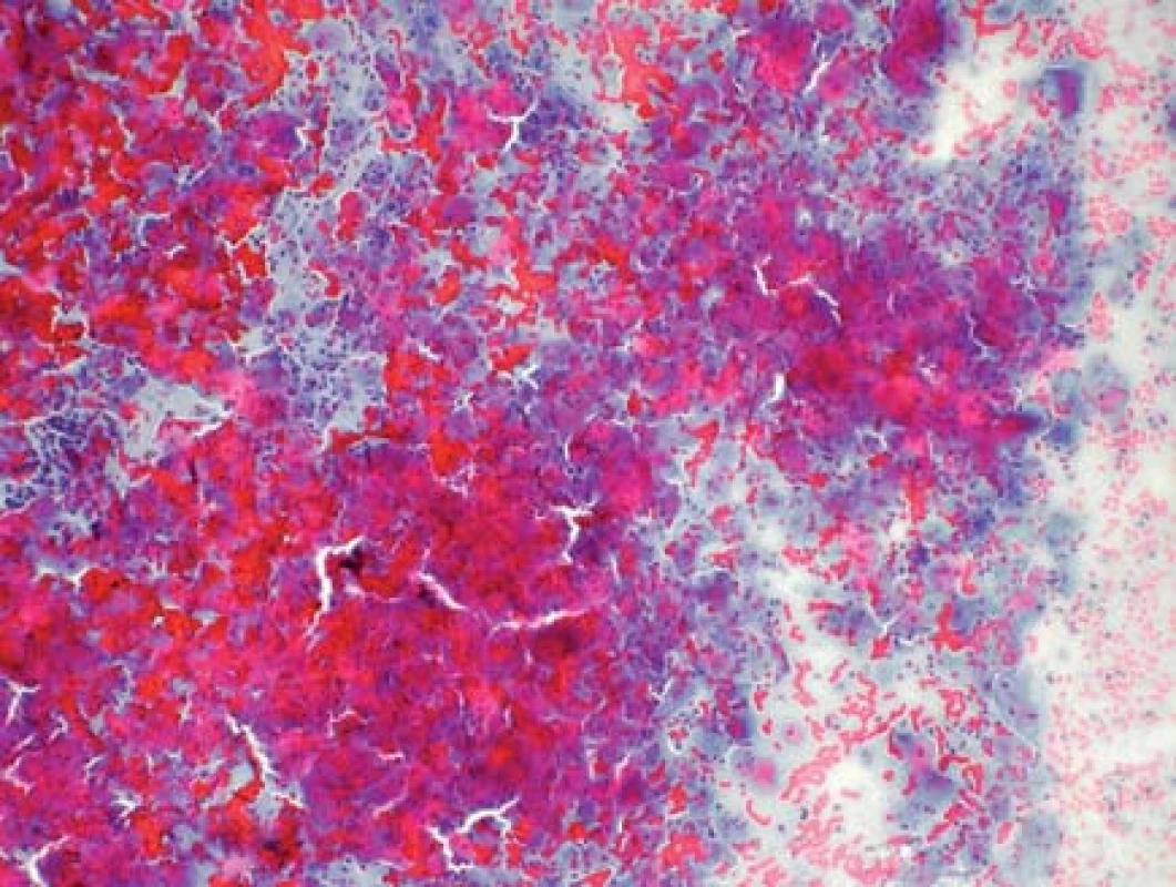 Konvenční cytologie s buněčnými shluky, s příměsí krve a polynukleárními leukocyty, NILM (základní screeningové zvětšení – 100×)
