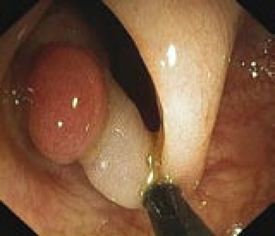 Stopkatý polyp v endoskopickém obraze během kolonoskopie těsně před snesením kličkou (vlastní materiál).