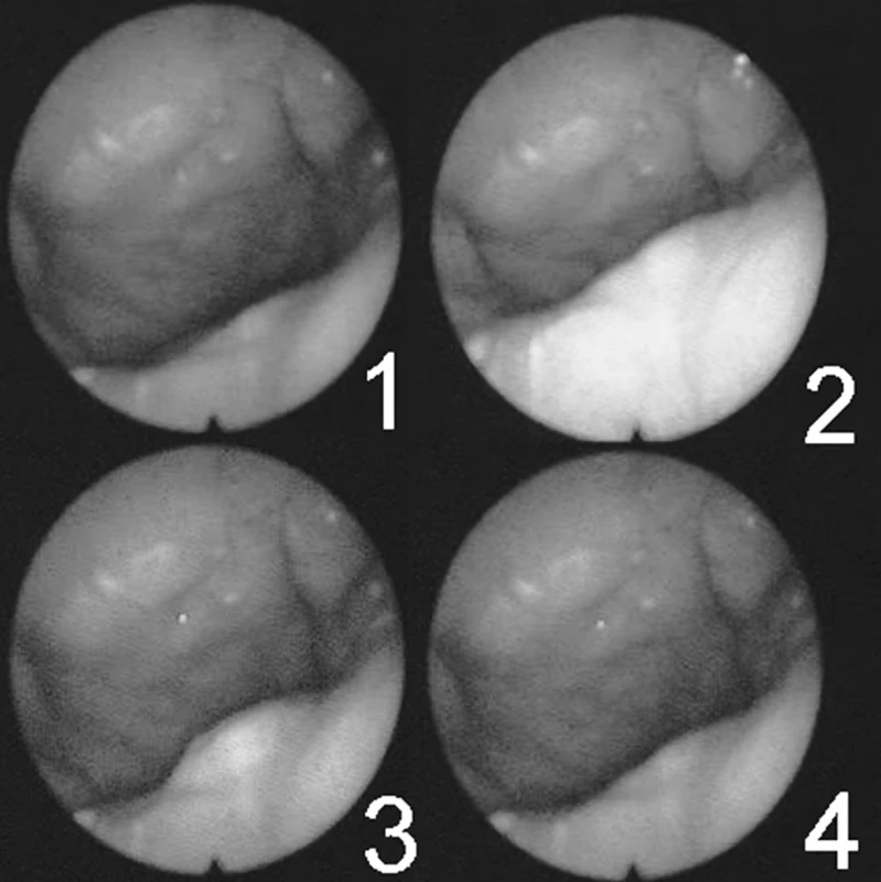 Série snímků zachycující pohyby velofaryngeálního uzávěru během artikulace (maximum uzávěru představuje číslo 3).