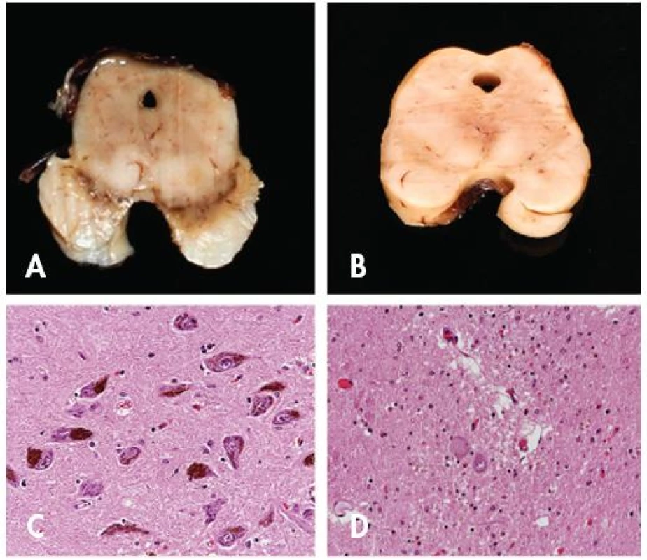 Porovnání nálezu u Parkinsonovy nemoci a normy. Patrná je výrazná atrofie mezencefala a dekolorací substantia nigra u pacienta s PN (B) ve srovnání se zdravou kontrolou (A). Mikroskopicky je pak zřetelná výrazná numerická atrofie pigmentovaných neuronů pars compacta substantiae nigrae u pacienta s PN (D) ve srovnání se zdravou kontrolou (C). Původní zvětšení 200x.