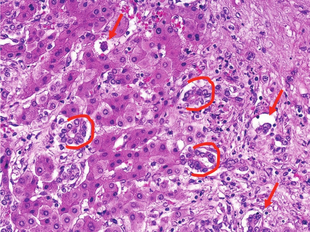 Epiteloidní hemangioendoteliom
Nádor věrně napodobuje tubulární struktury (označeno červeně), které jsou typické pro karcinomy, a navíc cholangiokarcinom i EHE mají nápadnou fibroprodukci. To činí diferenciální diagnostiku velmi obtížnou. 
Fig. 5: Epithelioid hemangioendothelioma 
The tumor mimics the tubular architecture (red lines) which is typical for carcinoma. Moreover, cholangiocellular carcinoma also shares stromal fibrotic tissue around the tumor cells with EHE. Therefore the differential diagnosis can be very difficult.