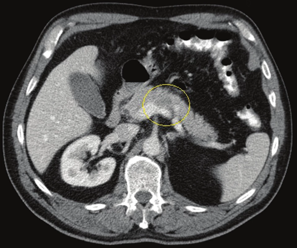 CT břicha, portální fáze, tumor těla pankreatu s invazí do slezinné žíly