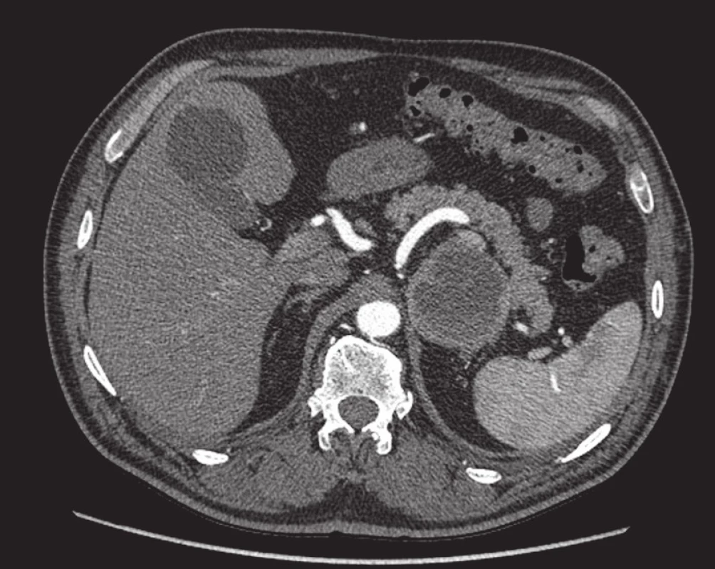 Feochromocytom. V místě levé nadledviny nad horním polem levé ledviny je patrné nápadné kulovité ložisko, jehož periferní části se po i. v. aplikaci kontrastní látky intenzivně sytí. Vpravo je patrná zcela normální nadledvina. Postkontrastní sken v transverzální rovině.
Fig. 4. Pheochromocytoma. In the left adrenal gland above the upper pole of the left kidney, a conspicuous spherical mass is seen; its peripheral portions are intensely enhanced following intravenous contrast agent administration. On the right, a perfectly normal adrenal gland can be seen. Post-contrast scan in the transverse plane.