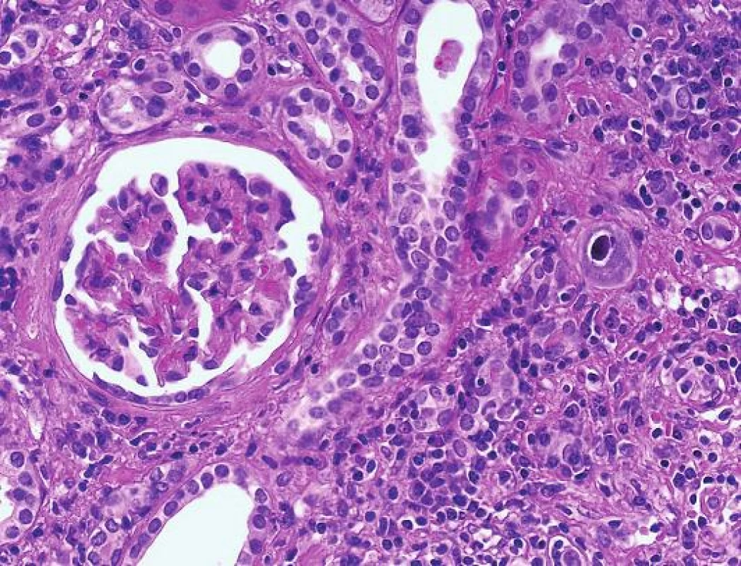 CMV infekce. Nápadně zvětšená buňka s jadernou inkluzí a s typickým perinukleárním halo (šipka) v nejisté lokalitě (HE, objektiv 40x).