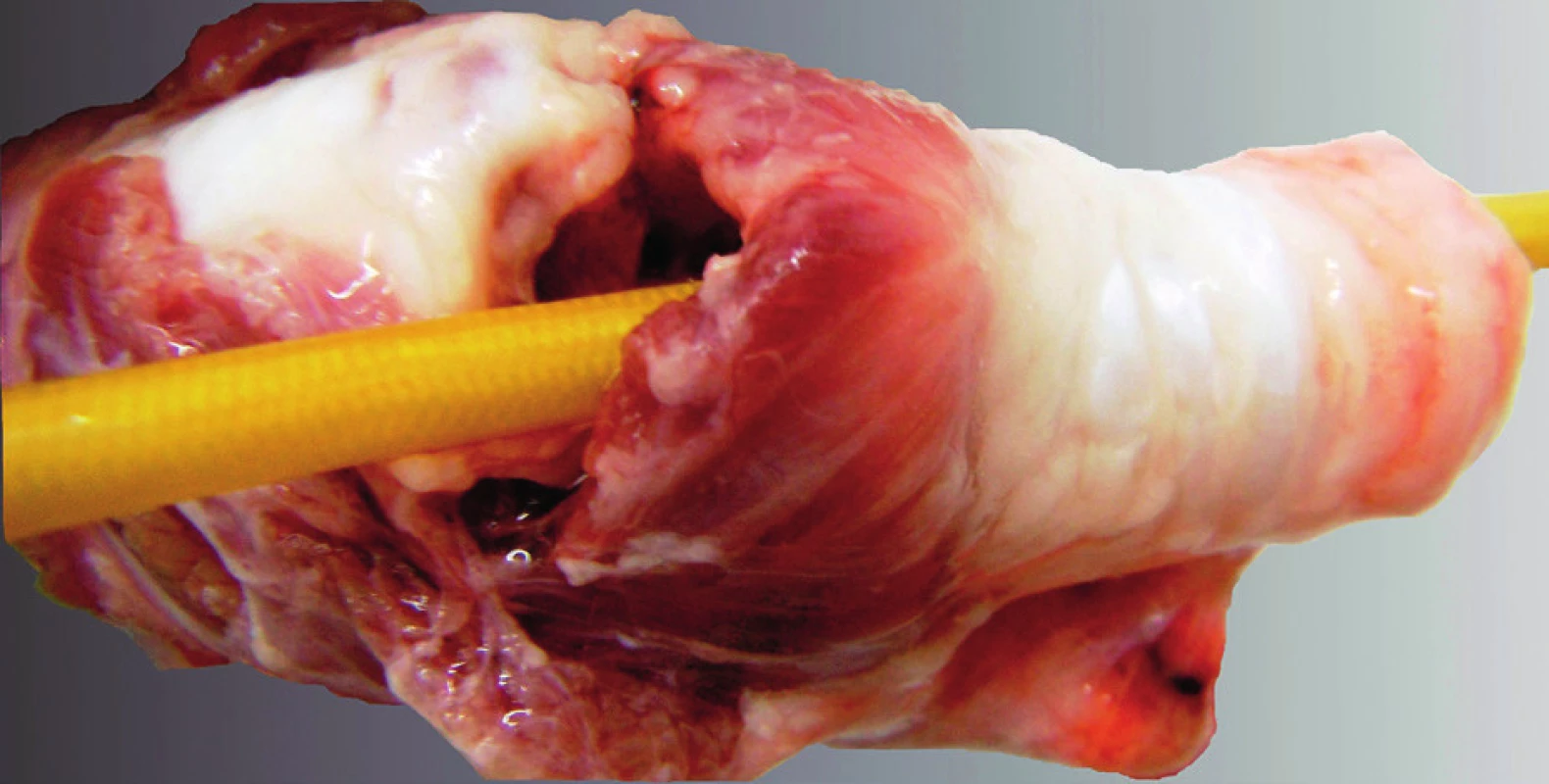 Anatomická preparace trachey s řezem skrz ligamentum cricothyroideum a zavedenou bužií