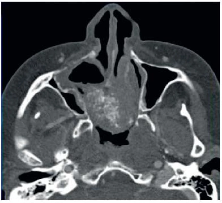 Axiální CT řez – kontrolní vyšetření s parciální remisí