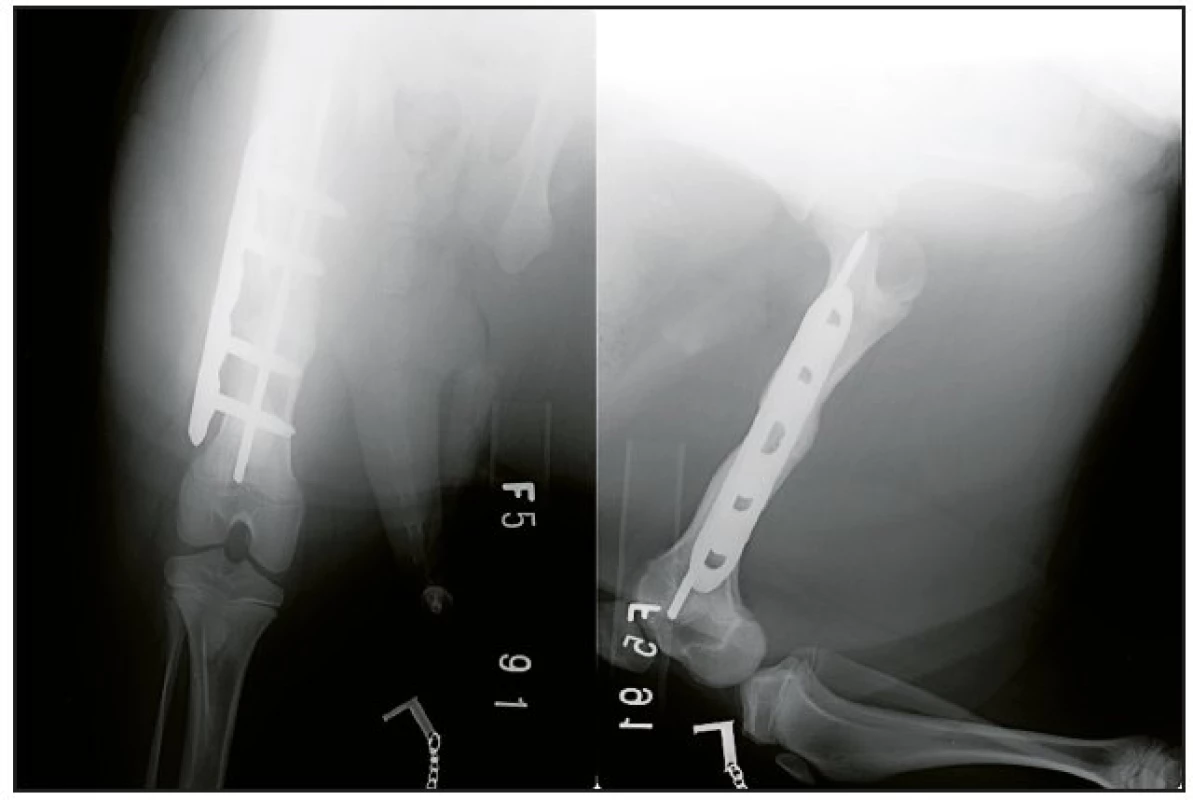 L femur prasete - zavedená LCP dlaha a intramedulárně Ki drát 3,0mm