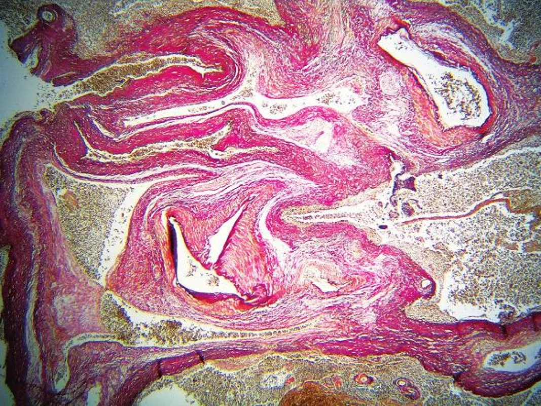 Arteriovenózna malformácia sleziny. Farbenie van Gieson + elastika (zväčšenie 25x).