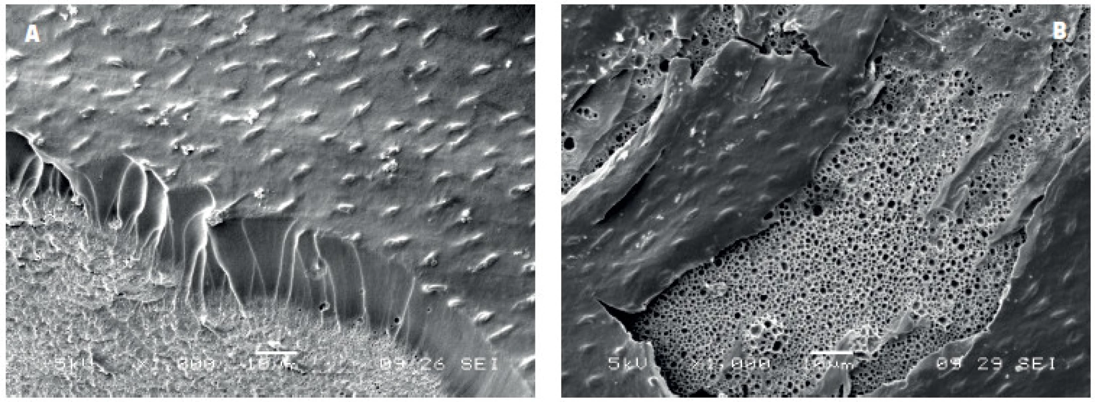 Spodní část kompozitní výplně bondované adhezivem ADP po odstranění skloviny a dentinu demineralizací a deproteinizací pomocí HCl a NaOCl: A) vrstva ADP s nedokonale vytvořenými pryskyřičnými tagy a drobnými bublinkami na rozhraní mezi kompozitním materiálem a vrstvou adheziva, B) rozsáhlé oblasti porozity na spodině vrstvy adheziva v kontaktu s kompozitním materiálem, zvětšení 1000x, SEM