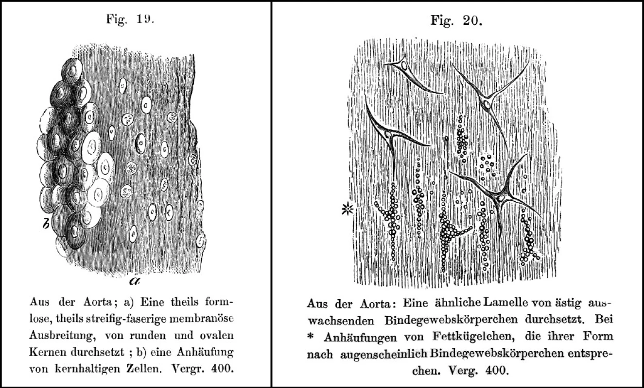 Histologické obrazy (dřevoryty) intimálních lézí aorty. 
Vlevo nakupení jader v pseudomembráně, vpravo vazivové buňky obsahující tukové kapénky [?pěnité buňky]

