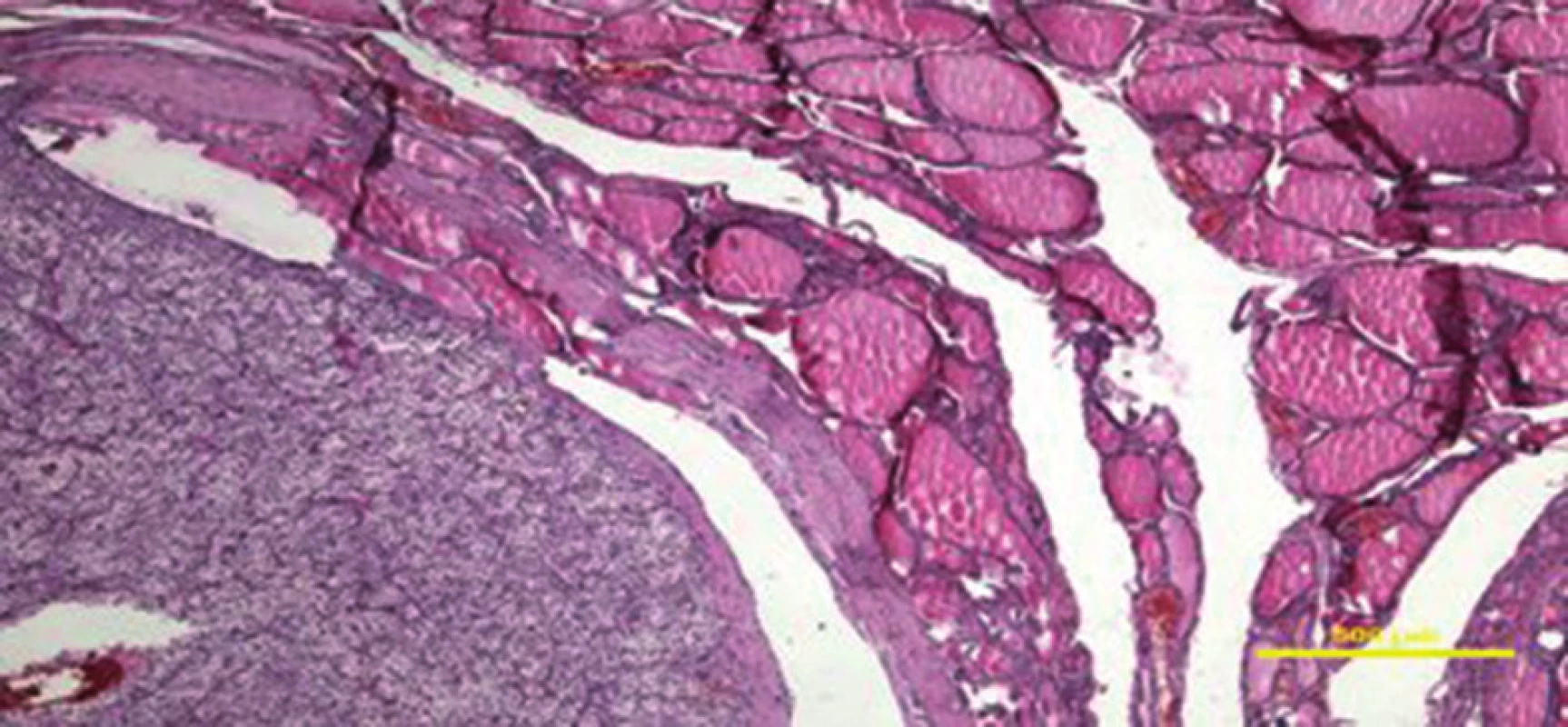 Histologický obraz – metastáza vlevo dole
Fig. 3: Histological image – metastasis below on the left