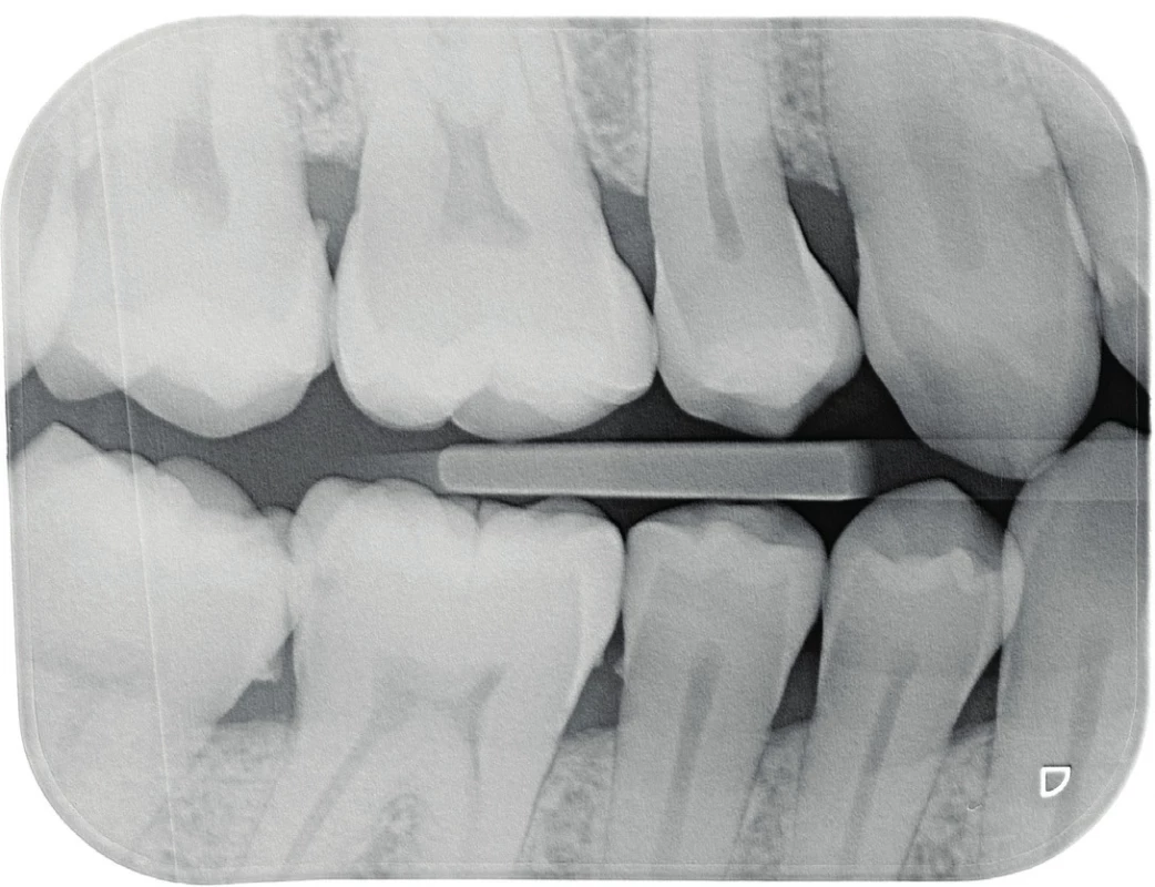 Na rentgenovém snímku bite-wing nelze odečíst přítomnost kazu, je-li demineralizace tvrdých zubních tkání menší než 30 %