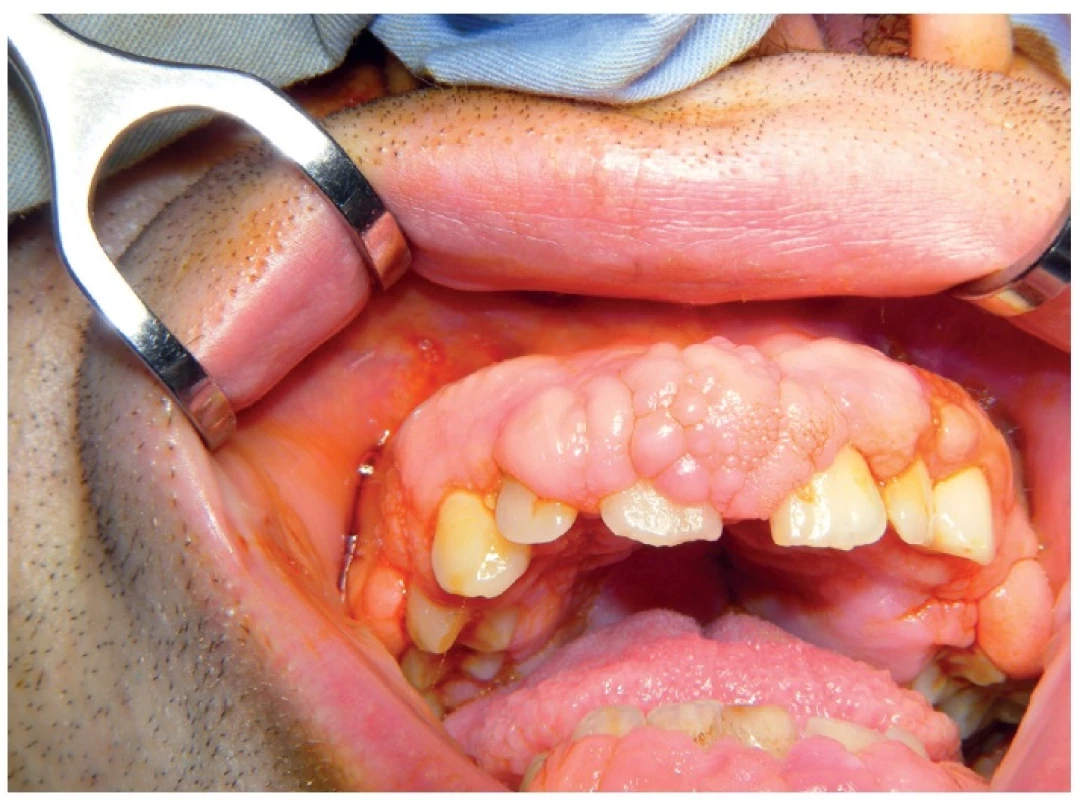 Pacient s idopatickou fibróznou hyperpláziou maxily a mandibuly ako 25-ročný