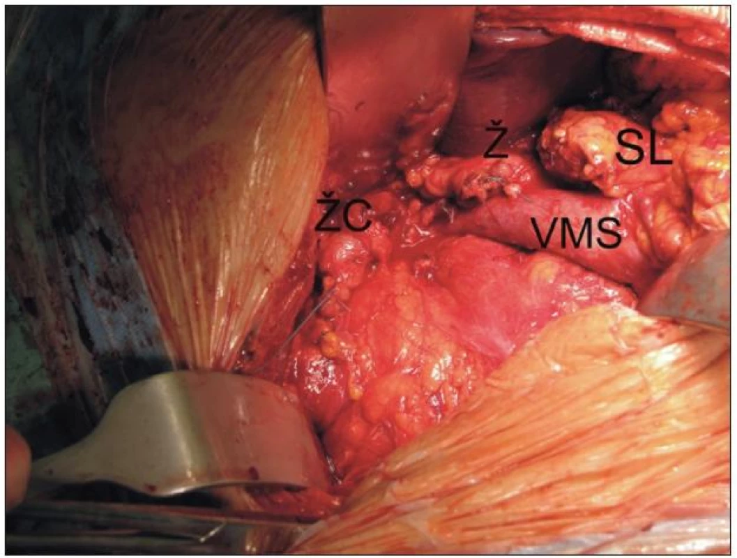 Pohled do operačního pole - stav po ukončené resekční fázi duodenopankreatektomie podle Whippla pro karcinom. Je patrný pahýl žaludku (Ž), pankreatu (SL) žlučových cest (ŽC) a kompletně vypreparovaná horní mezenterická žíla (VMS).
