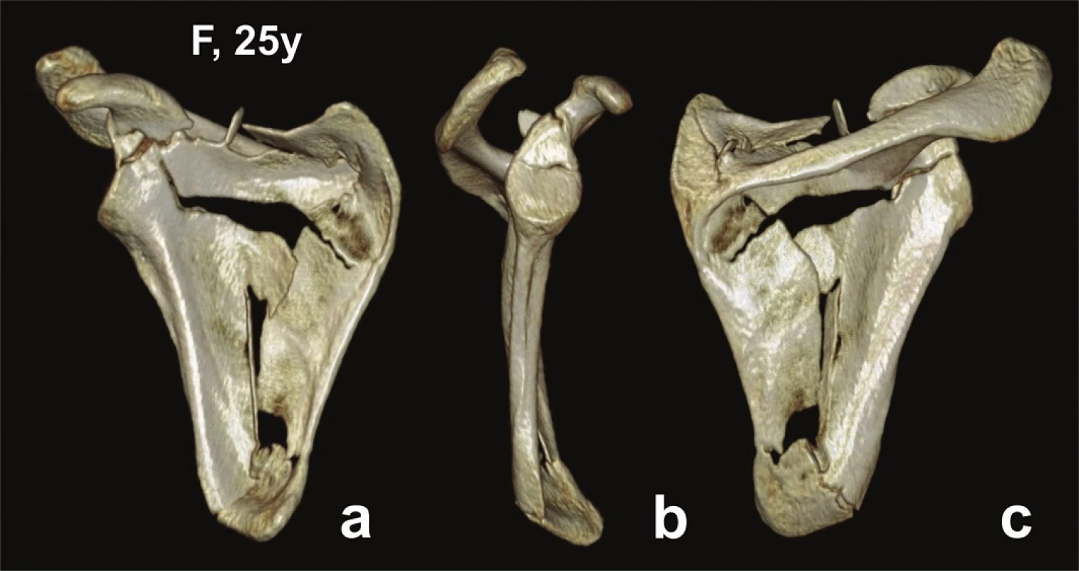Glenoid fossa fractures (two fragments) with separation in the scapular body − CT 3D reconstructions (Pt − 10)