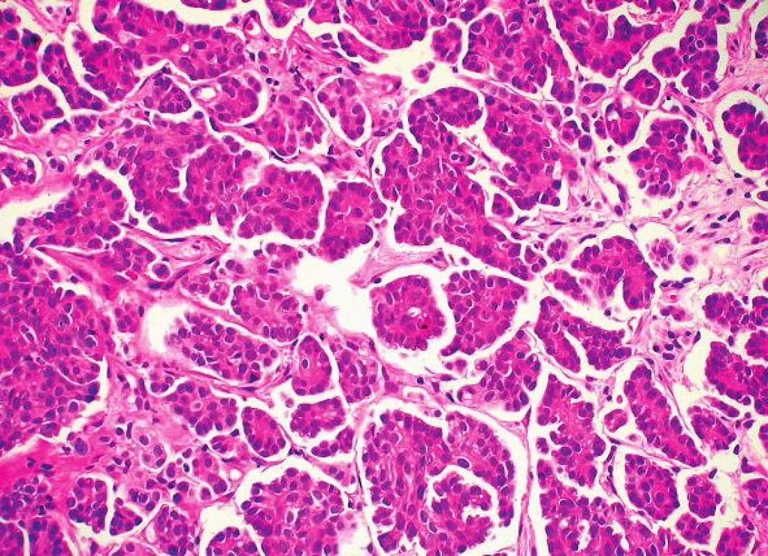 Metastáza serózního (papilárního) karcinomu ovaria neodlišitelná od primárního mikropapilárního karcinomu prsu