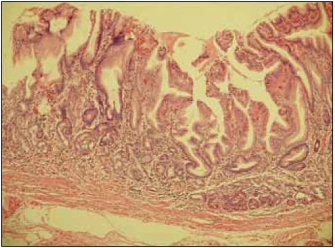 Průřez stěnou žaludku se známkami atrofie sliznice, s redukcí žlázové vrstvy, v lamina propria mucosae je vidět chronická zánětlivá celulizace. Zvětšení 100krát.