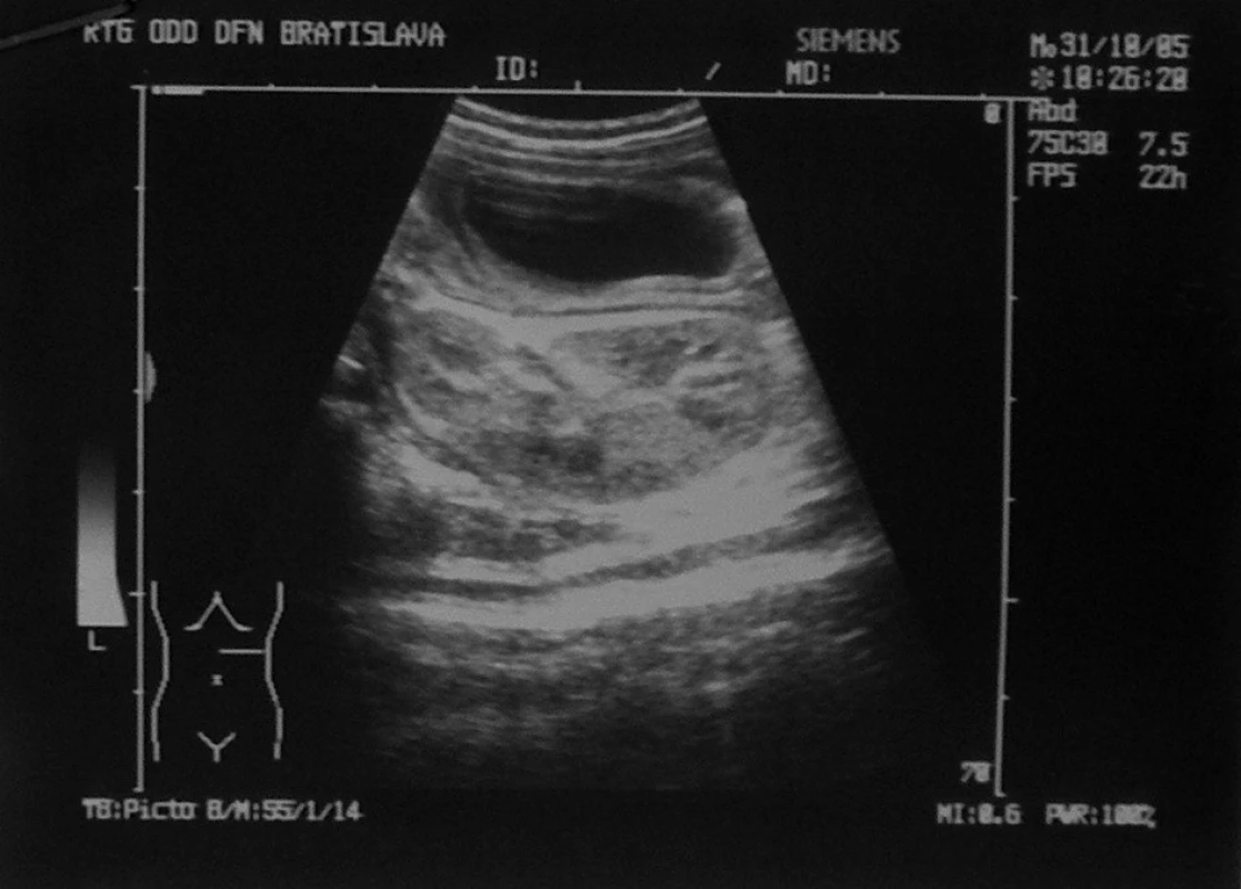 Sonografický nález, cysta s hrubou stenou pred obličkou.
Fig. 1. Sonographic finding, a cyst with a thick wall in front of kidney.