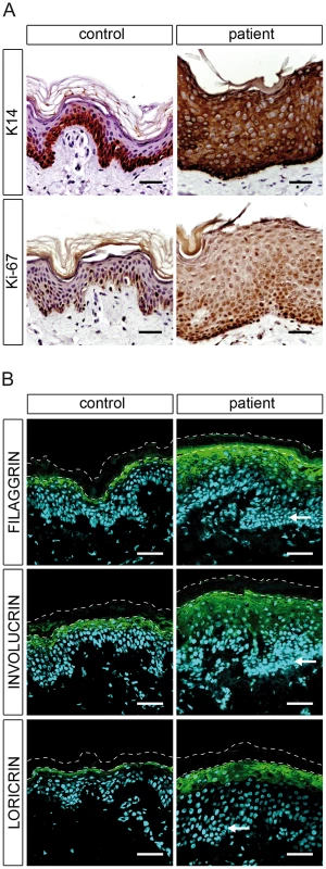 Epidermal differentiation in healthy control and patient H.