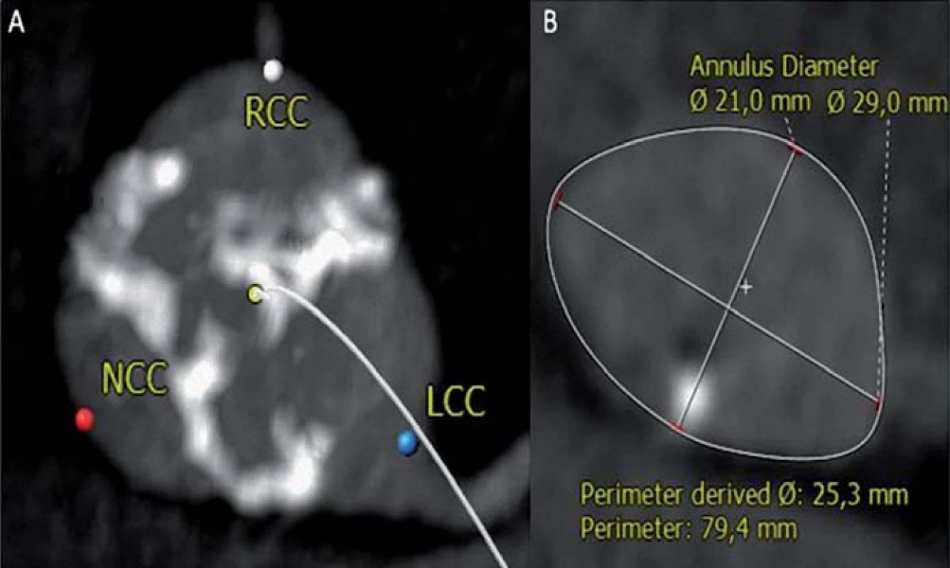 Trojcípá aortální chlopeň je symetrická v úrovni cípů (A), ale aortální anulus je výrazně eliptický (B) s velikostí (perimetr/π) 25 mm. Měření aortálního anulu pomocí jícnové echokardiografie typicky hodnotí kratší osu, v tomto případě bylo změřeno 21 mm.