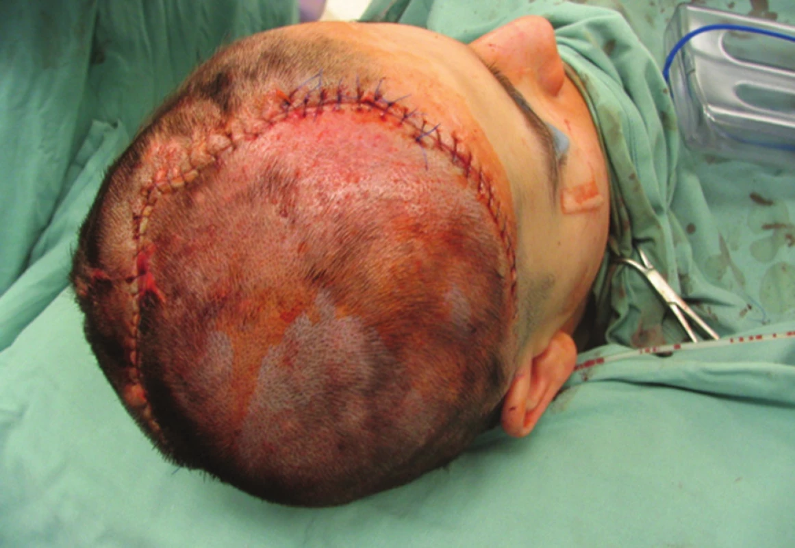 Pacient po explantaci tkáňového expandéru pro korekci posttraumatické alopecie