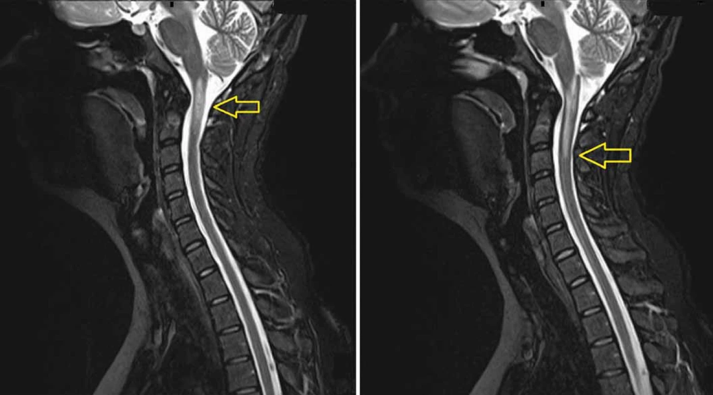 MRI (T2 vážený obraz) provedená 8 měsíců po protonovém ozáření.
Snímky ukazují radionekrózu v prodloužené a horní krční míše (A) zasahující až do úrovně C3 (B). Radionekróza je mimo původní lokalizaci tumoru.